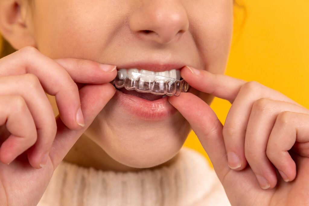 cosmetic braces01